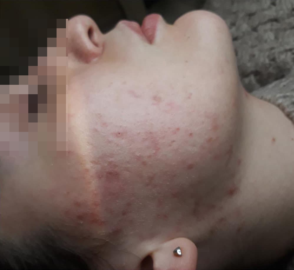 Higijenski tretman Medeja pre